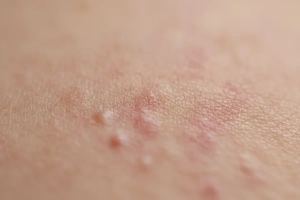 DIY IPL at Home: 2026 Risks for Skin Safety